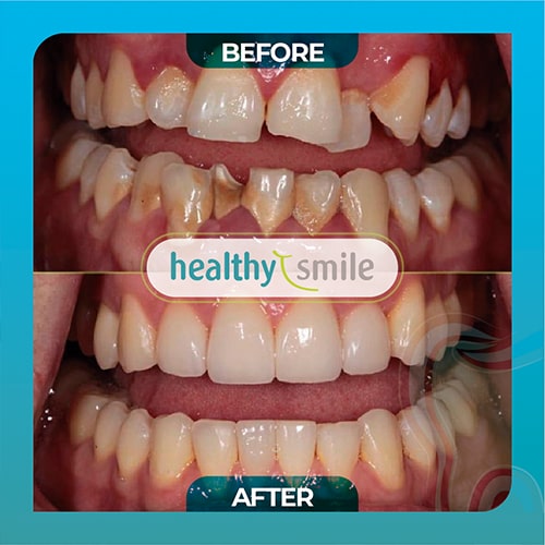 Dr Fig Healthy Smile Before & after dental implants